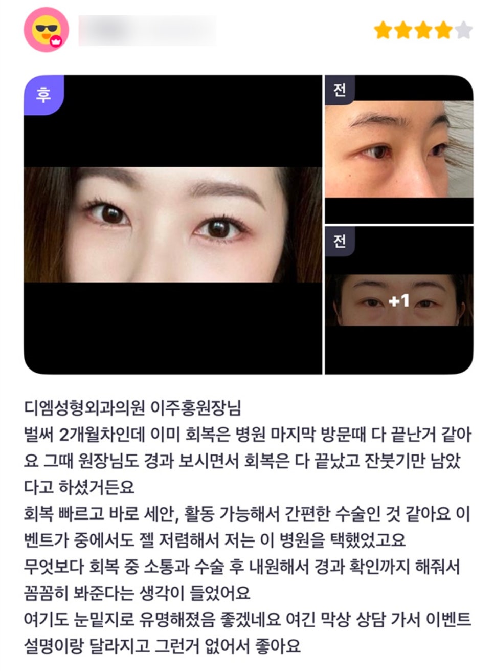눈밑지방재배치 후기."꼼꼼히 봐줘서 좋고 유명해지면 좋겠어요!" 관련 이미지 1
