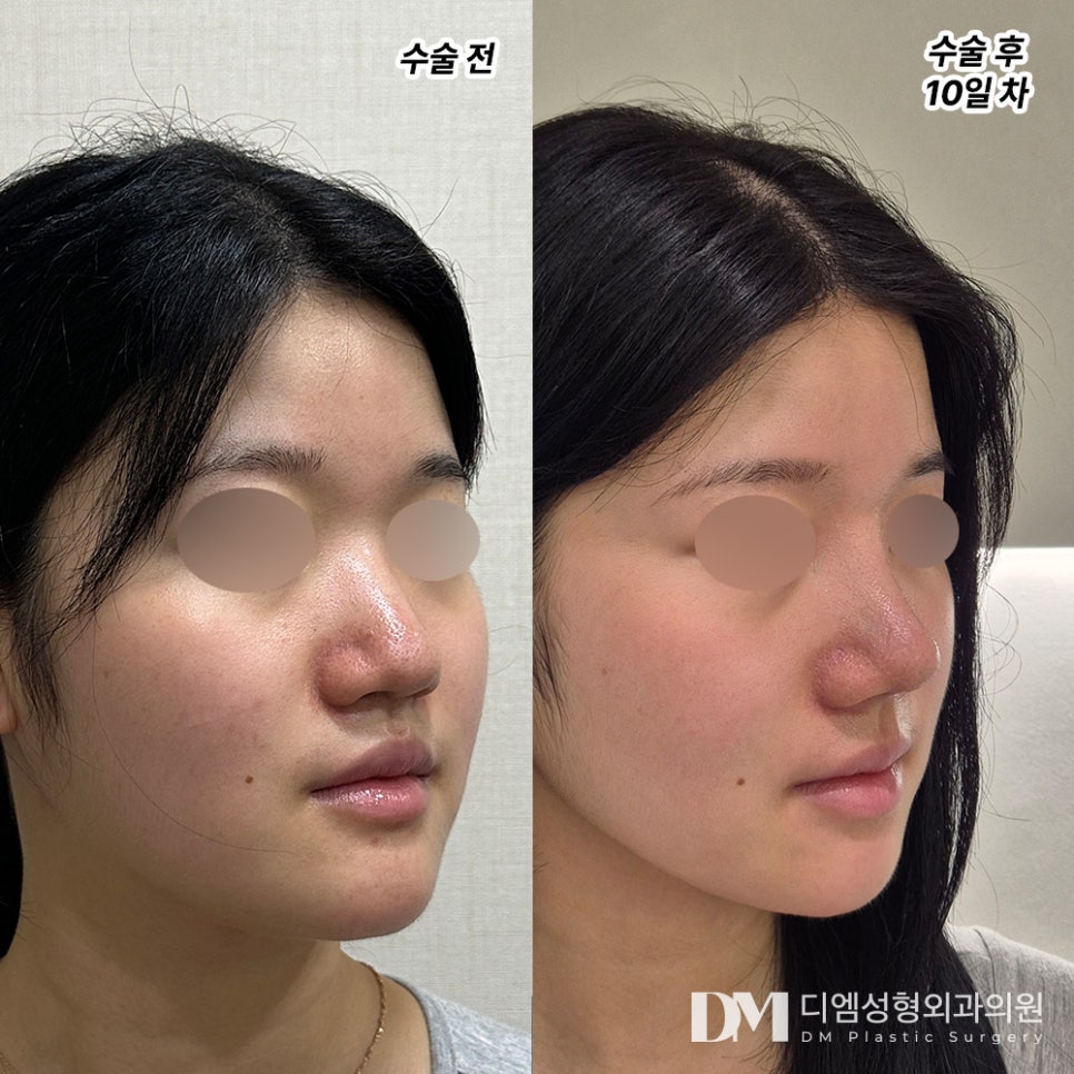 Revision Rhinoplasty Review. "I’m satisfied every time I look in the mirror!" image 2