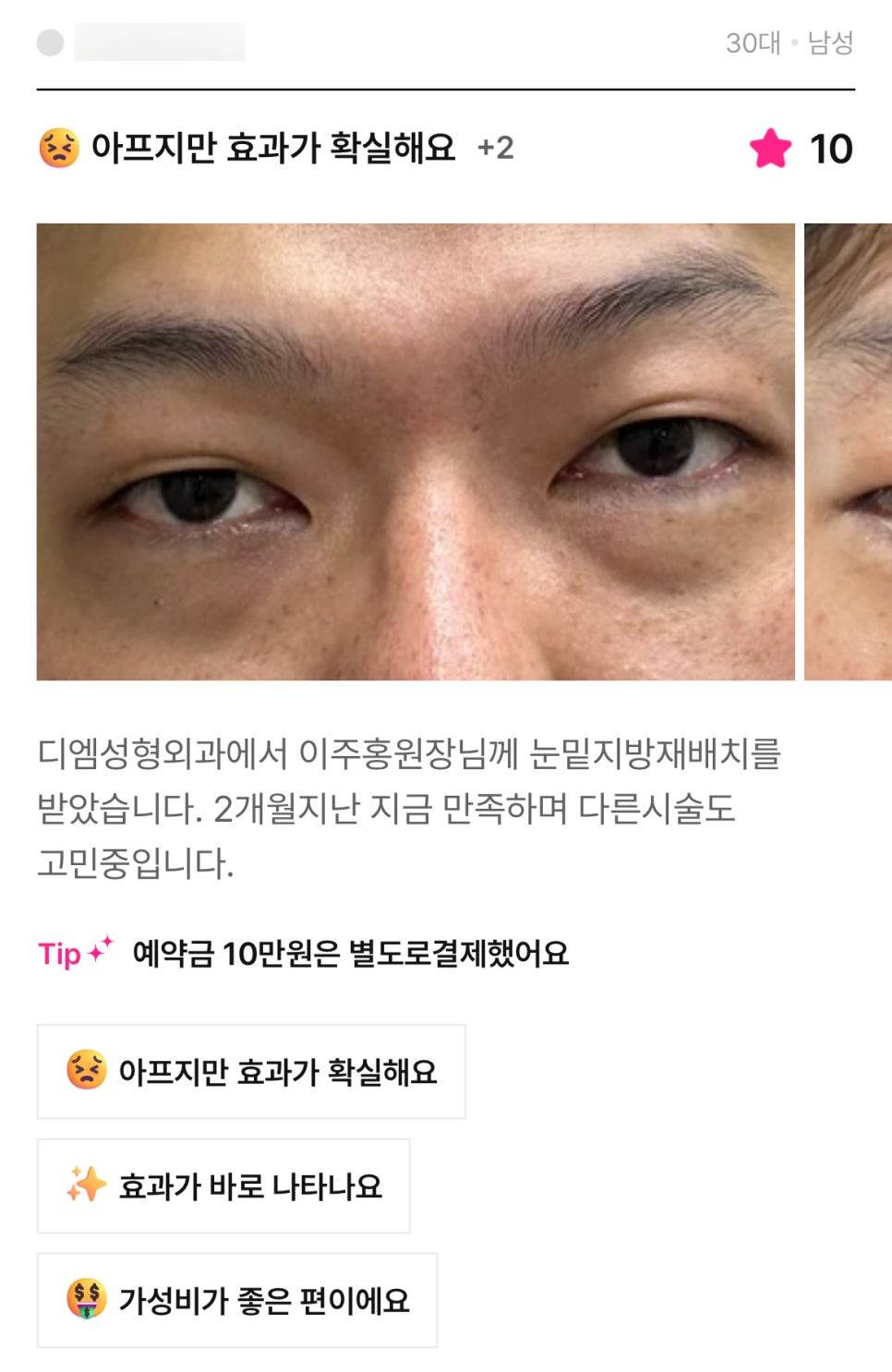 눈밑지방재배치 후기."2개월이 지난 지금 너무 만족합니다!" 관련 이미지 1