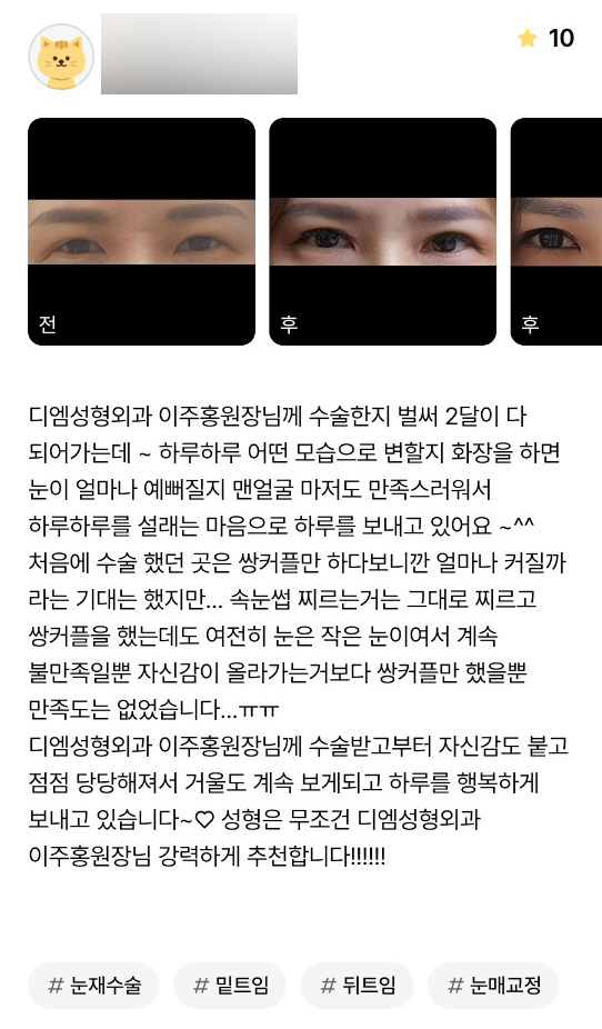 Eye Plastic Surgery Review: “I’m happily going through each day after surgery!” image 1