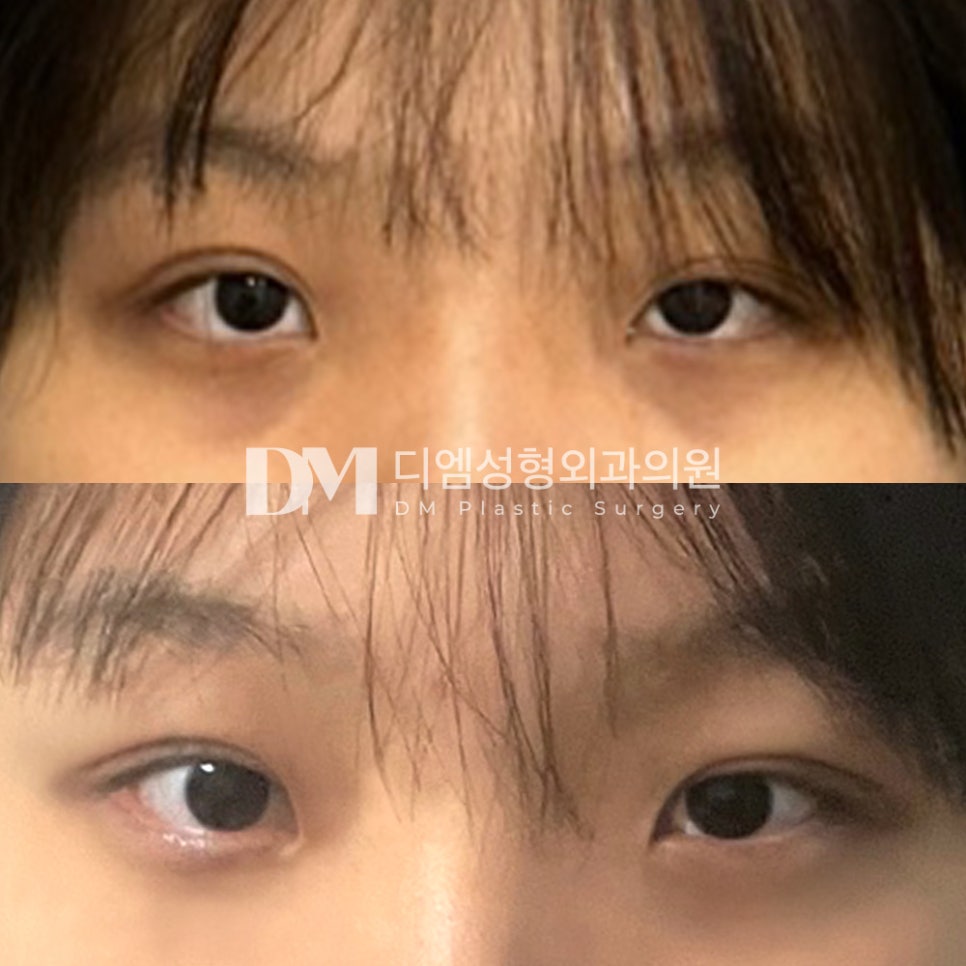 눈성형 후기."티 하나도 안나고 너무 마음에 들고 예뻐요!" 관련 이미지 2