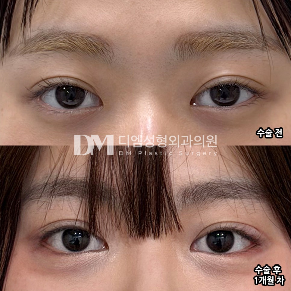 DM Ppang Ttim Surgery Review, “I feel more satisfied every time I look in the mirror!” image 2