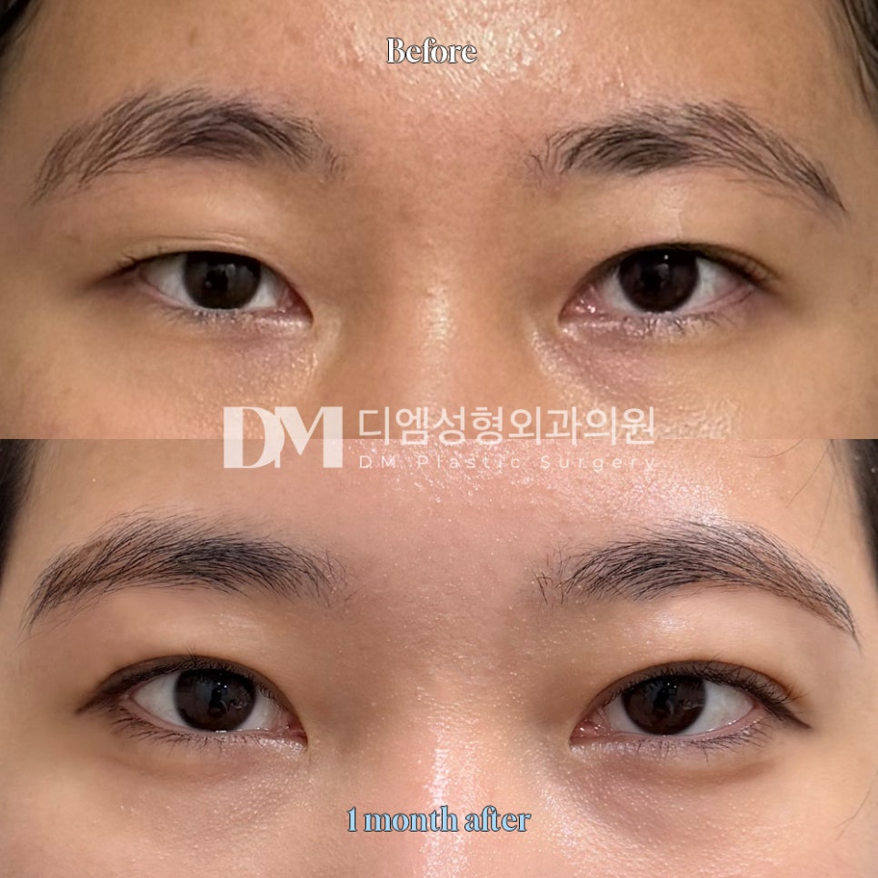 Review of Double Eyelid Revision Surgery. "It looks natural, so overall I’m very satisfied!" image 2