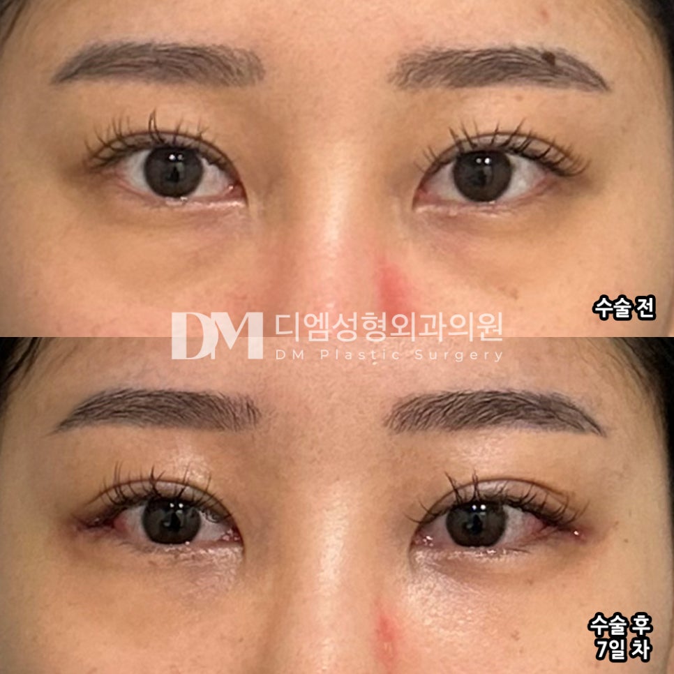Eyelid Surgery Review. "I was so glad they only recommended the surgery I had been considering because it was stressful!" image 2