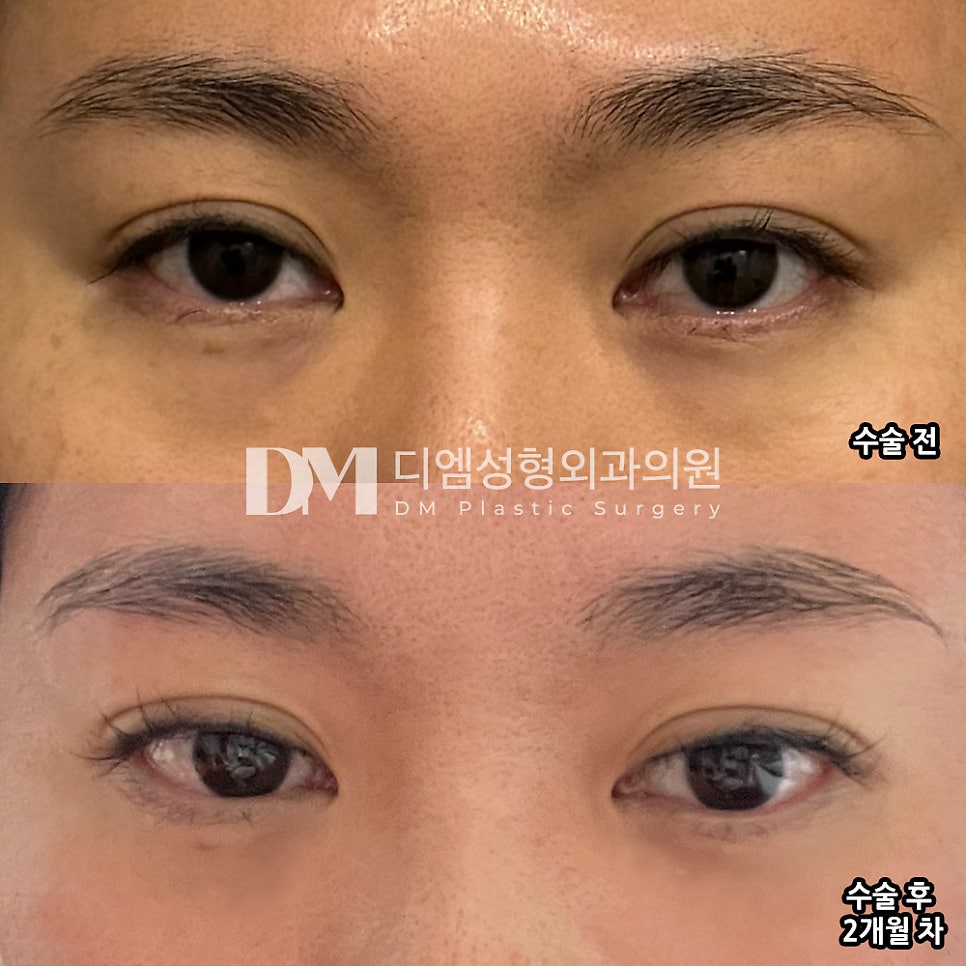 눈밑지방재배치 후기."양쪽 눈이 좀 더 대칭이 된 것 같은 부수적인 효과까지 만족합니다!" 관련 이미지 2