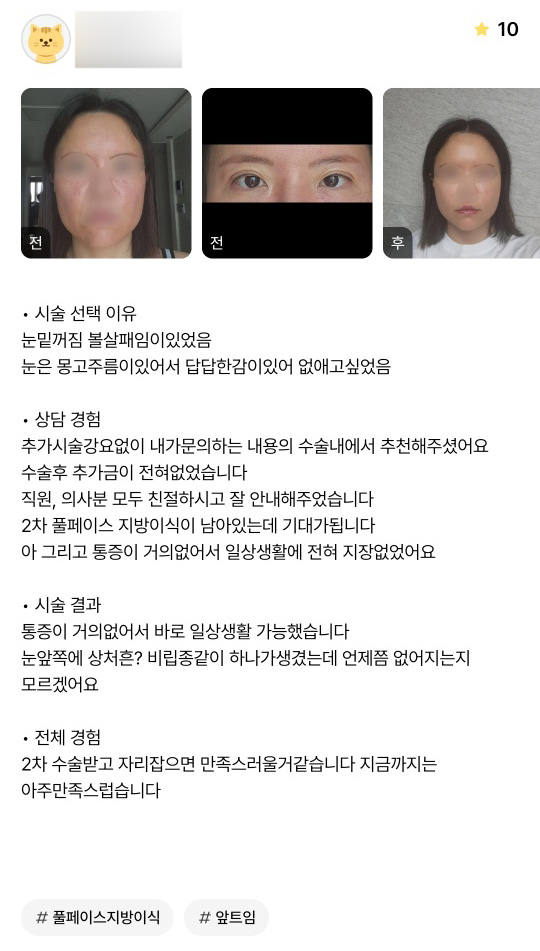 Double Eyelid Surgery Review. "There was almost no pain, so it didn’t affect my daily life at all!" image 1