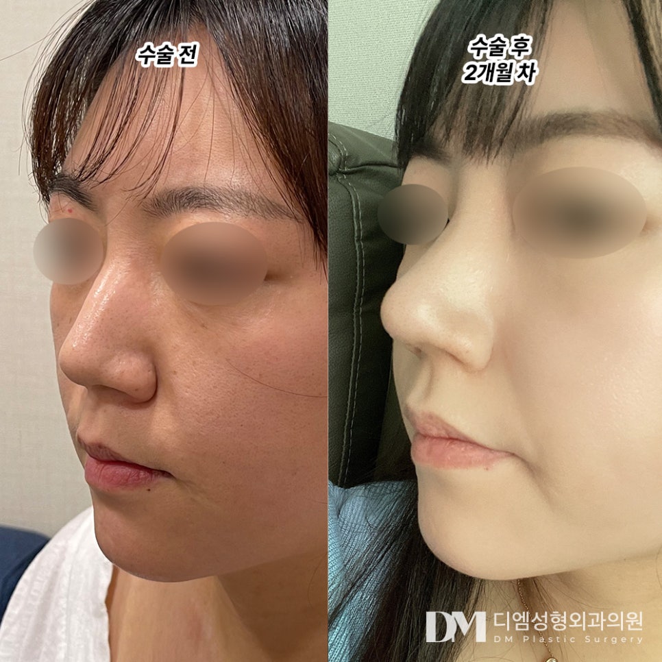 Nose Surgery Review. “I like it even more because it looks so natural that no one can tell I had nose surgery!” image 2
