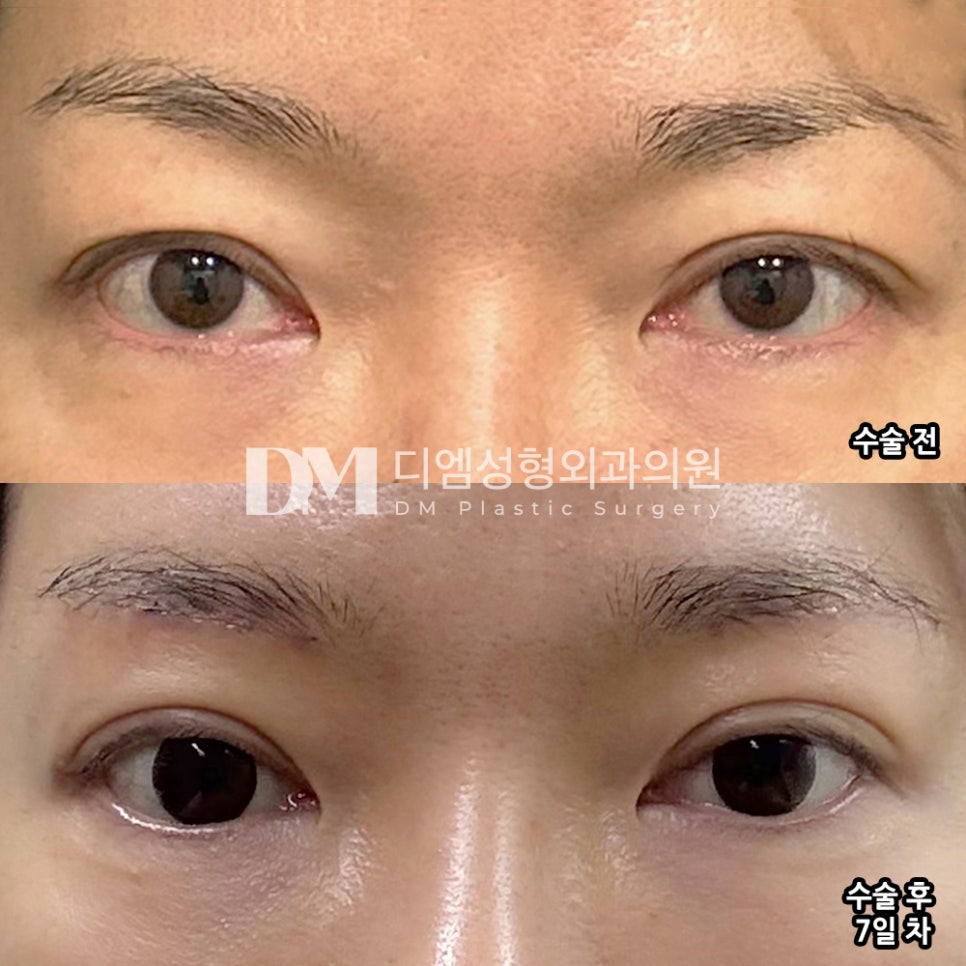 DM Brow Lift Surgery Review, “I’m satisfied with the doctor’s trustworthy consultation and the results!” image 2