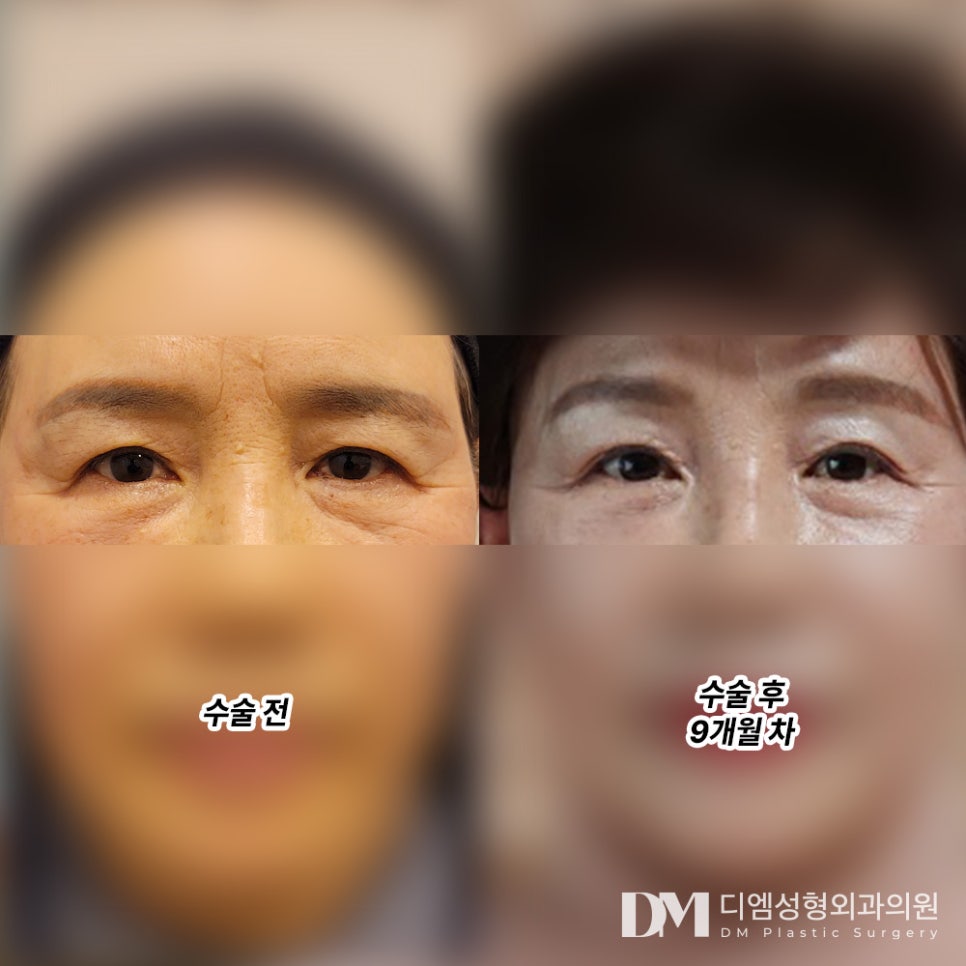 Forehead Lift, Improving Forehead Wrinkles and Crow’s Feet at the Same Time image 7