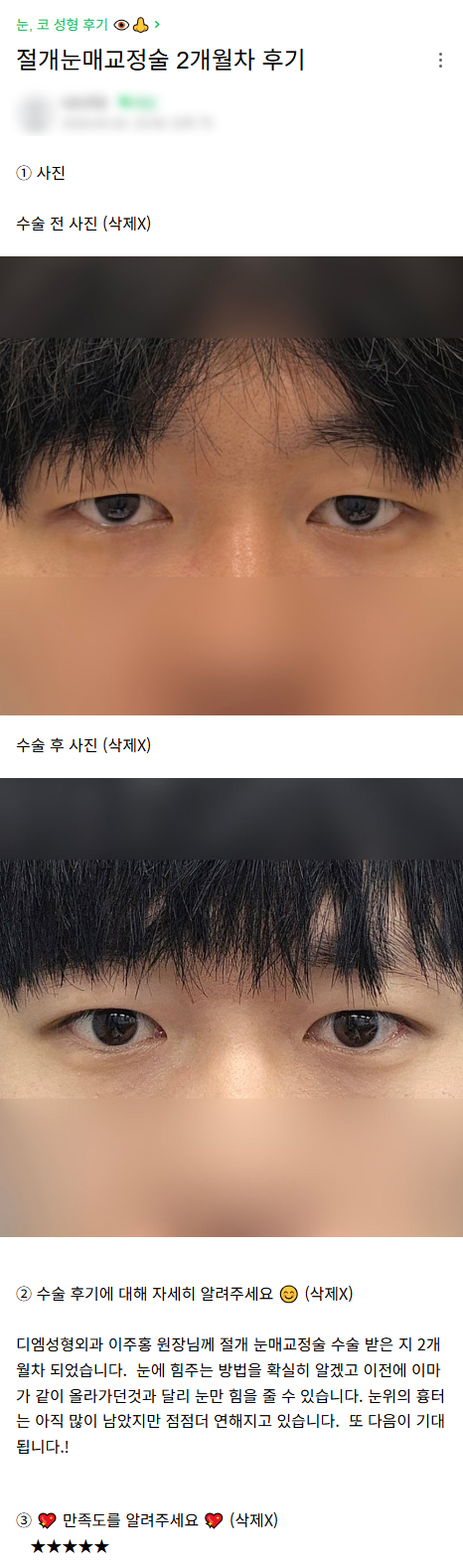 디엠 남자눈성형/남자눈매교정 후기, “수술 후 눈에 힘주는 방법을 확실히 알게 됐습니다!” 관련 이미지 1