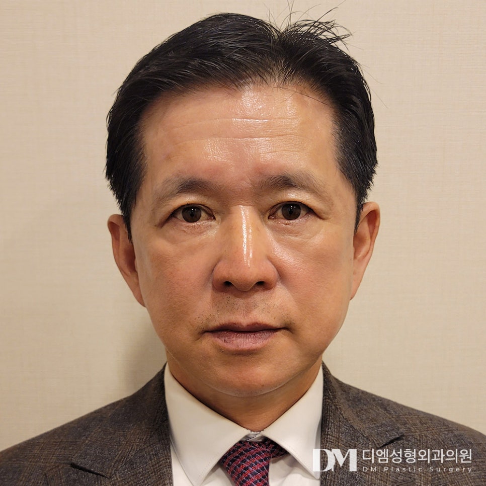 Improving Droopy Eyes with Upper Blepharoplasty image 1