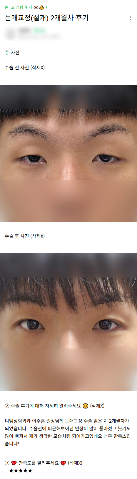 디엠 남자눈매교정/남자눈성형 후기, &ldquo;인상이 많이 좋아졌고 너무 만족스럽습니다!&rdquo; 관련 이미지 1