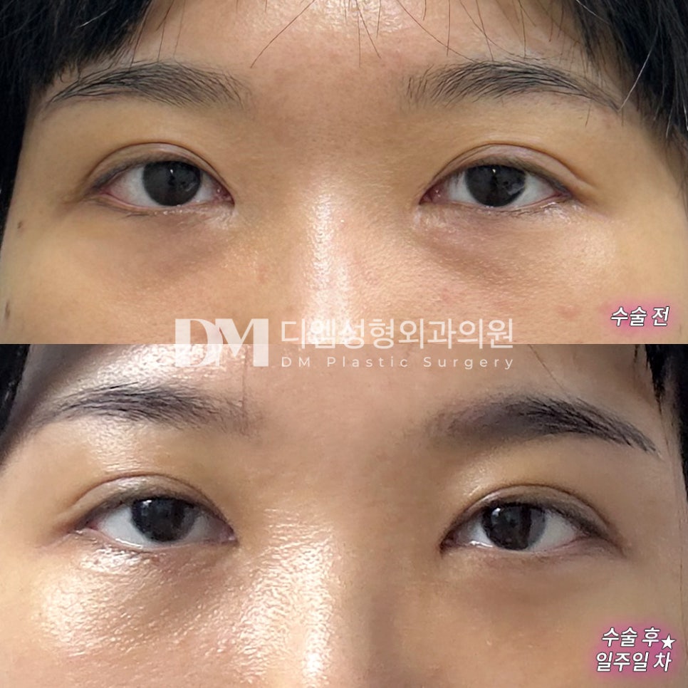 Under-Eye Fat Repositioning for a Brighter, More Refreshed Look image 6