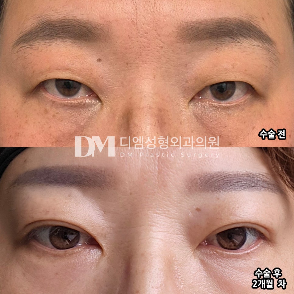 눈성형 후기."고민하지 마세요 고민만 하면 늦어요 " 관련 이미지 2