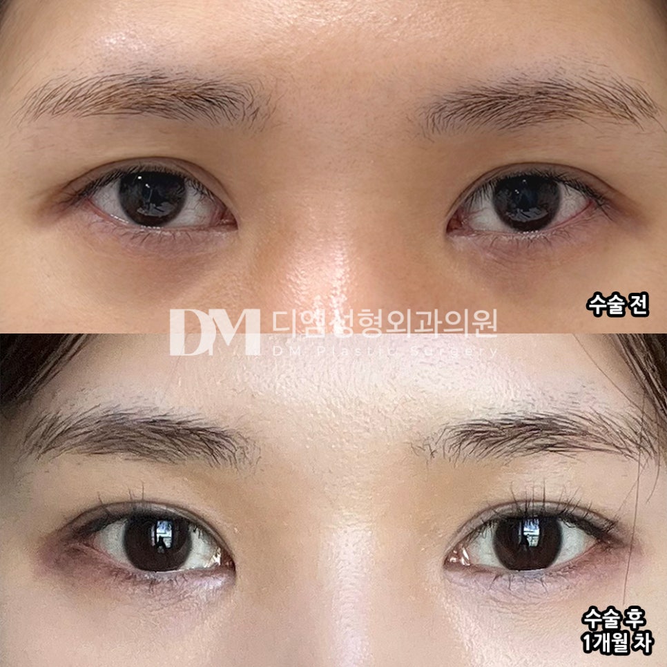 디엠 뒤밑트임/트임성형 후기, &ldquo;신경쓰였던 부분이 많이 교정돼서 좋아요!&rdquo; 관련 이미지 2