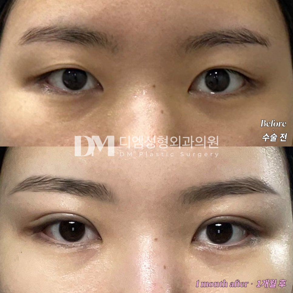 Blepharoplasty Revision Review. "I was glad I could get back to daily life quickly!" image 2