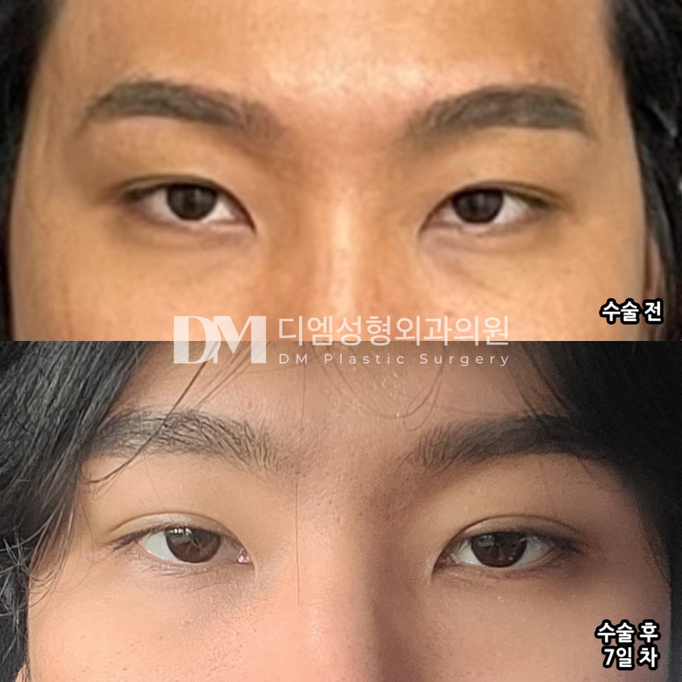 Review of Revision Eyelid Surgery. “I was glad I could proceed at a reasonable price!” image 2