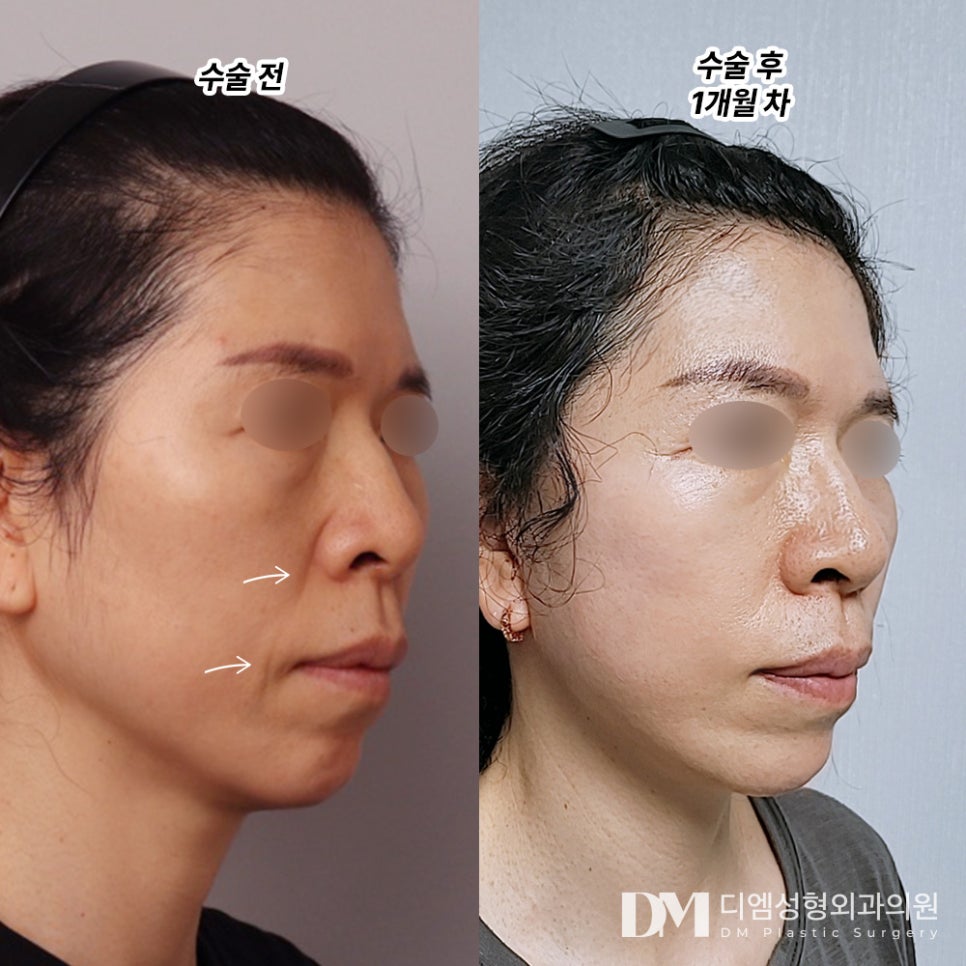 Facelift Review. "I felt relieved after the procedure because it was done so carefully." image 2