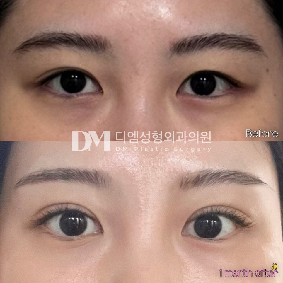 눈재수술 후기."신중하게 결정했는데 대만족입니다!" 관련 이미지 2