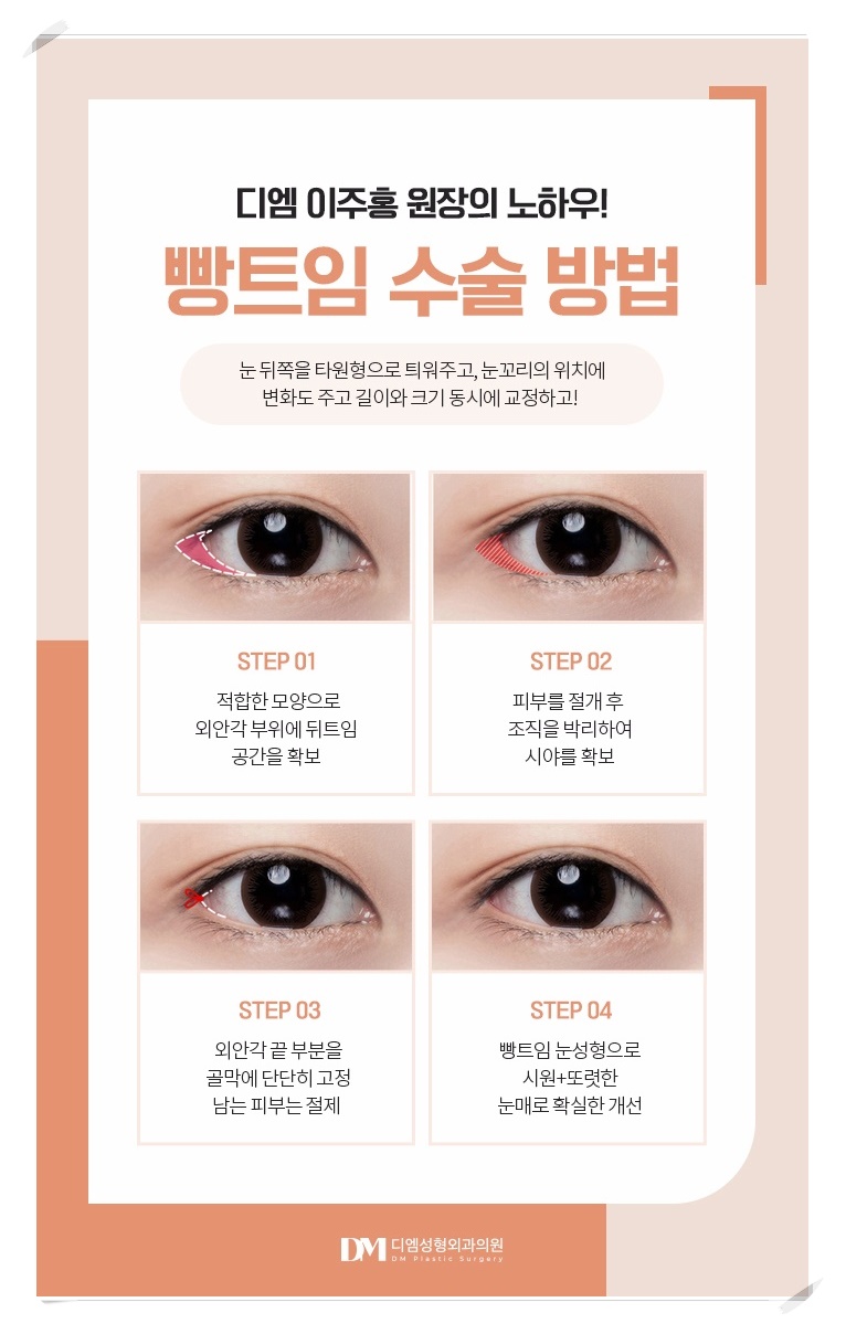 뒤밑트임, 흉터없이 순한 눈매로 관련 이미지 7