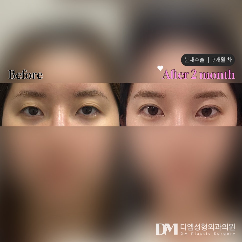 Revision Eyelid Surgery Review. "I’m so satisfied!!" image 2