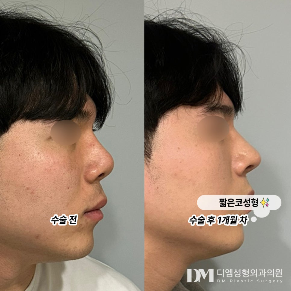 Planning Short Nose Surgery?! image 8