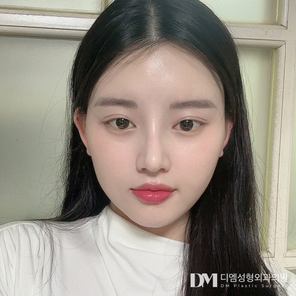 낮은코성형, 자연스럽게 입체감 살리기 관련 이미지 1