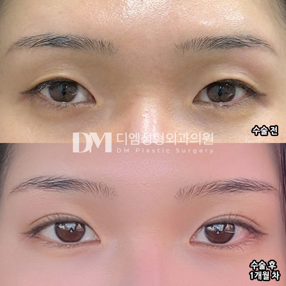 DM Eye Contouring/Outer and Lower Corner Widening Review, “They Said My Appearance Looks More Refined and Better After Surgery!” image 2