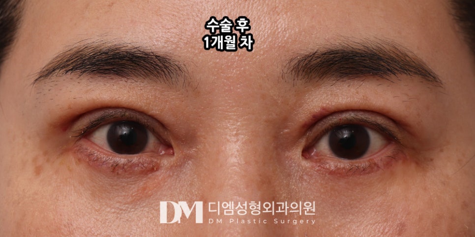 상안검, 눈꺼풀의 노화 해결하기 관련 이미지 11