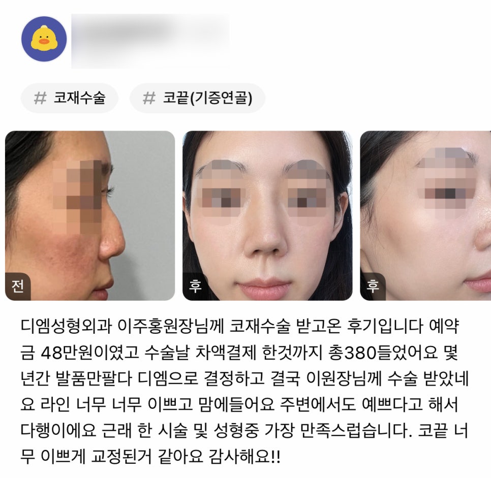 코재수술 후기."근래 한 시술 및 성형 중 가장 만족스럽습니다!" 관련 이미지 1