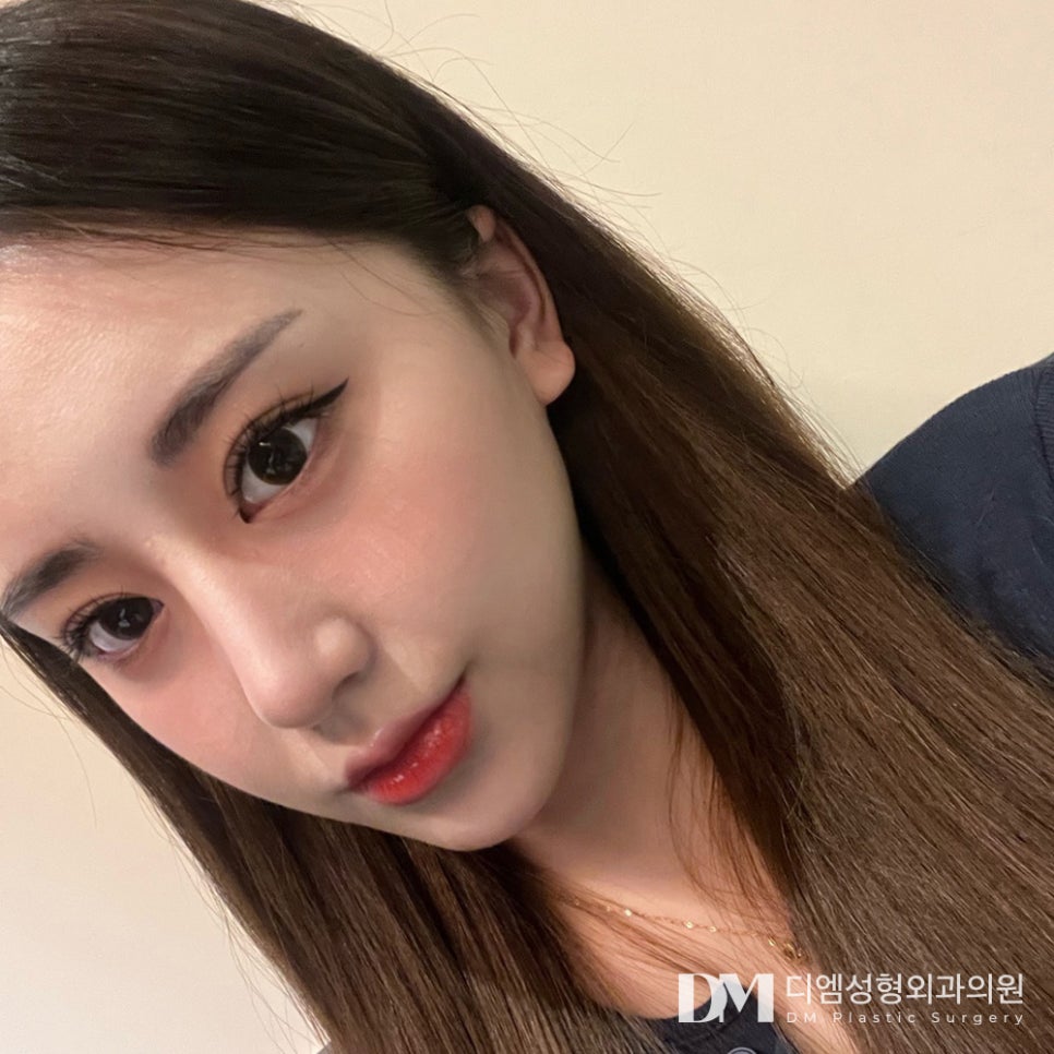 뒤밑트임, 자연스럽게 시원한 눈매로 관련 이미지 1