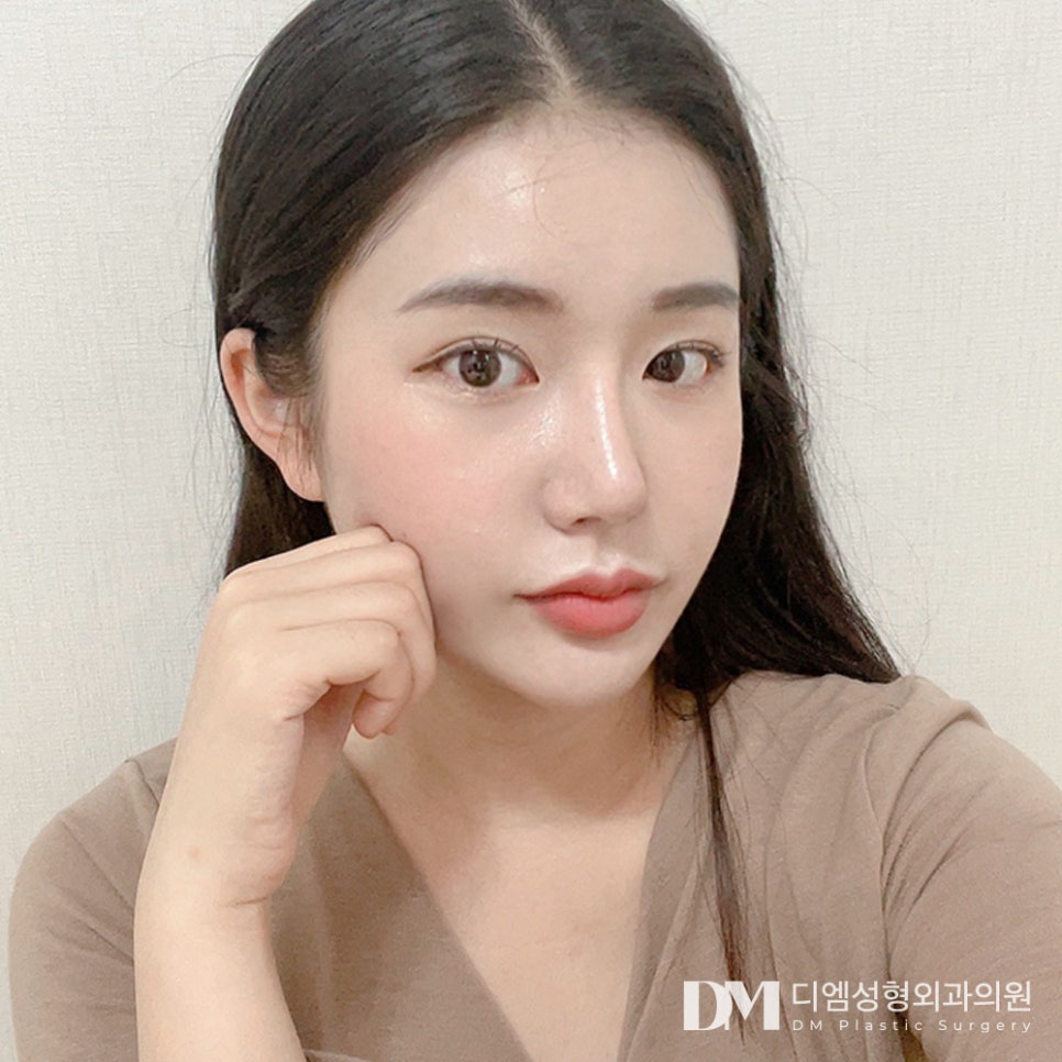 눈밑지방재배치, 안와격막 고정이 중요한 이유는? 관련 이미지 2