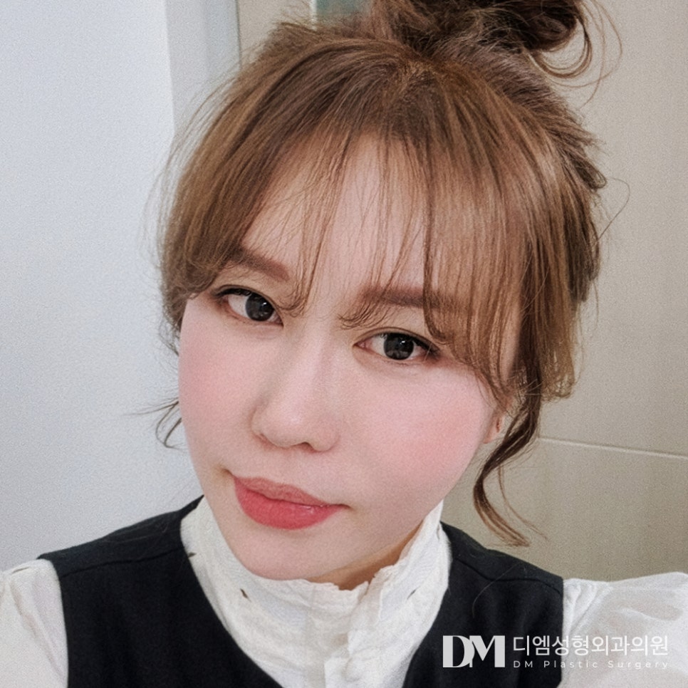 안면거상 나이, 몇 살에 하는 게 가장 효과적일까요? 관련 이미지 1