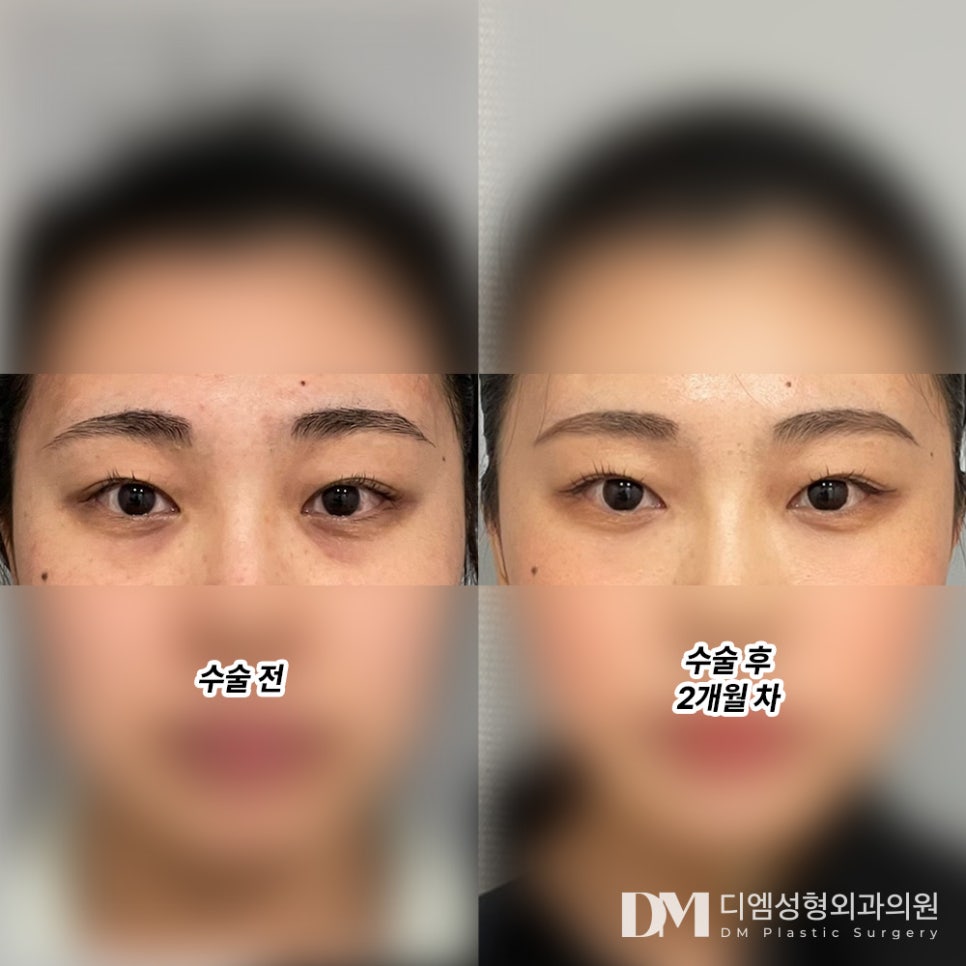 눈밑지방재배치 후기."눈 밑 라인이 깔끔해지고 밝아졌어요!" 관련 이미지 2