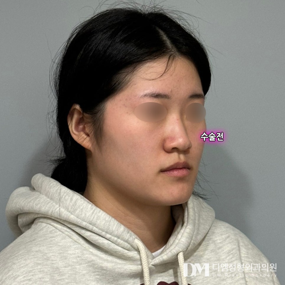 Tip Rhinoplasty: What If the Tip of Your Nose Looks Bulbous? image 8