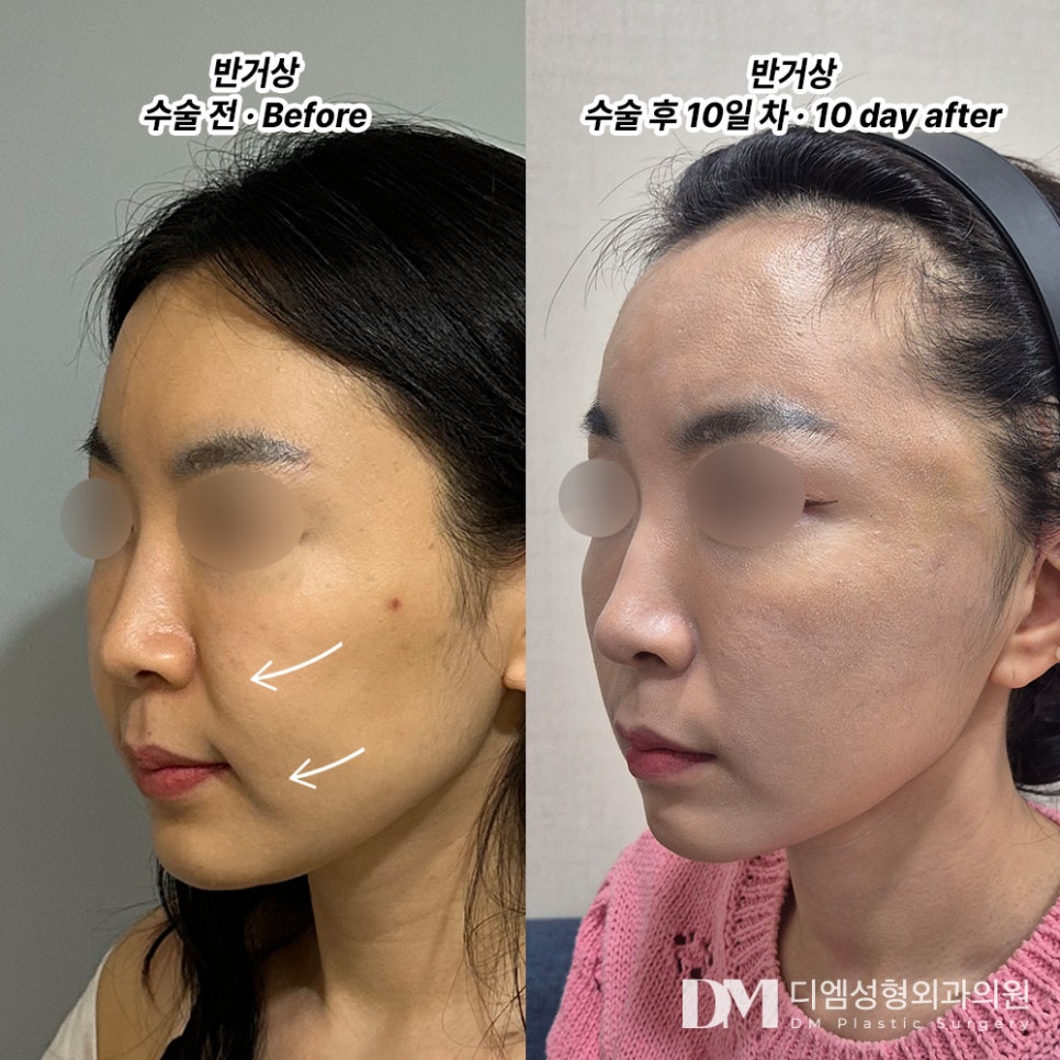 반거상, 흉터걱정은 덜고 리프팅 효과는 올리고! 관련 이미지 7