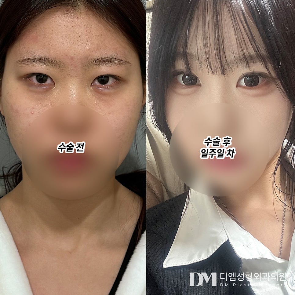 Double Eyelid Revision Surgery Review. "After the surgery, I had less bruising, the line was set so beautifully, and the swelling didn't go down unevenly, which I think made it even better." image 2