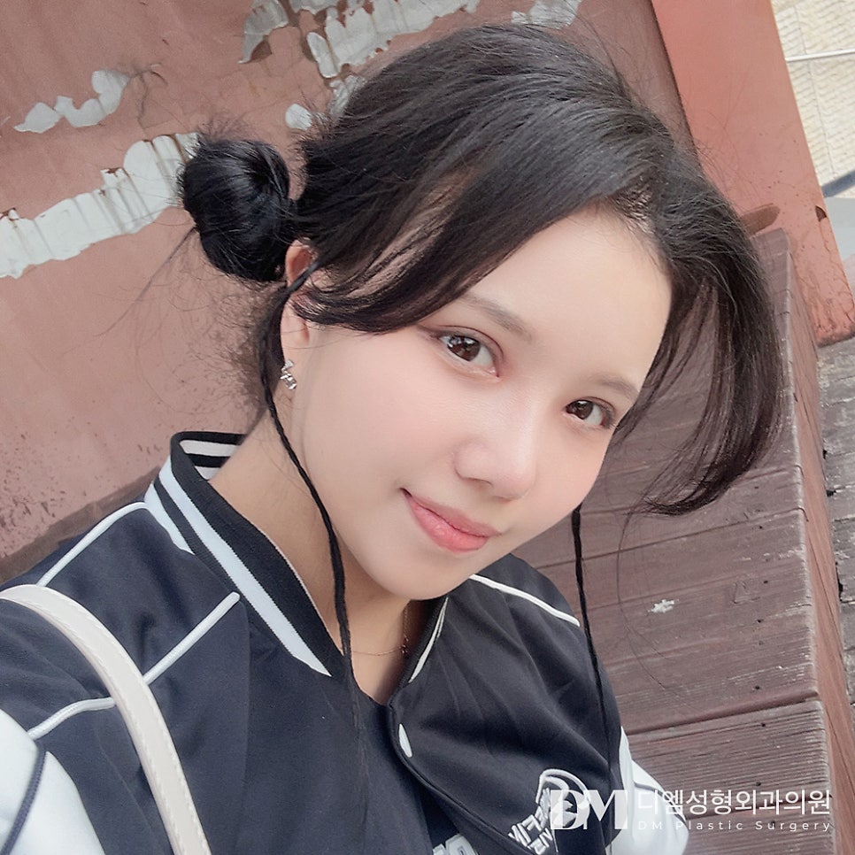 DM Long Nose Surgery: No More Midface Proportions Stress! image 11