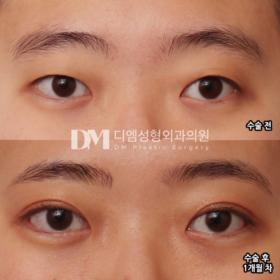 피곤하고 졸려보이는 눈 , 눈매교정으로 개선 가능할까? 관련 이미지 12