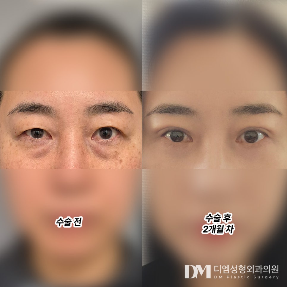 하안검으로 밝은 인상 만들기 관련 이미지 7