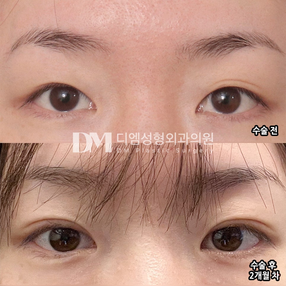 DM Eye Revision Surgery Before-and-After Photos—Because This Time Should Be the Last! image 2