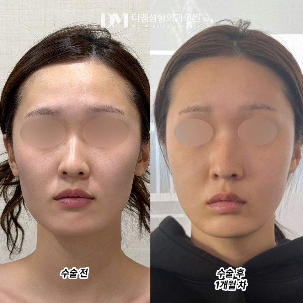 디엠 얼굴지방이식 전후사진, 자연스러운 불륨감과 입체감으로 고민 끝! 관련 이미지 2
