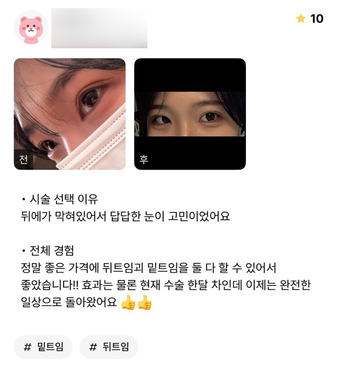 Bbang Eye Corner Surgery Review. “I was really glad that I could get both outer corner and lower corner surgery at such a good price!!” image 1
