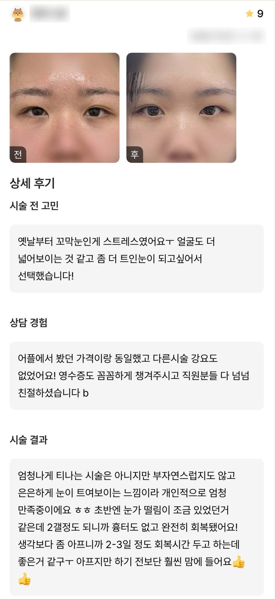 디엠 빵트임 수술후기, &ldquo;은은하게 눈이 트여 보이는 느낌이라 만족 중이에요!&rdquo; 관련 이미지 1