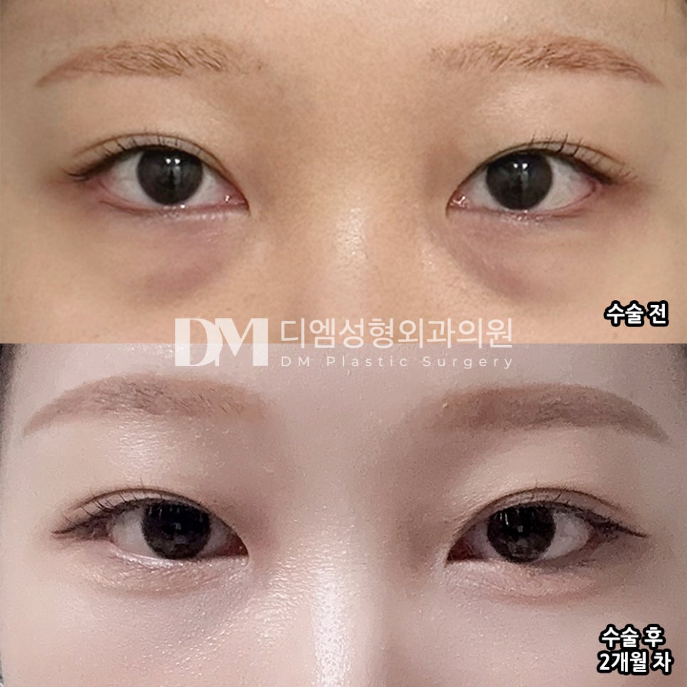 디엠 눈밑지방재배치 수술후기, “전체적으로 너무 만족스러운 수술이에요!” 관련 이미지 2