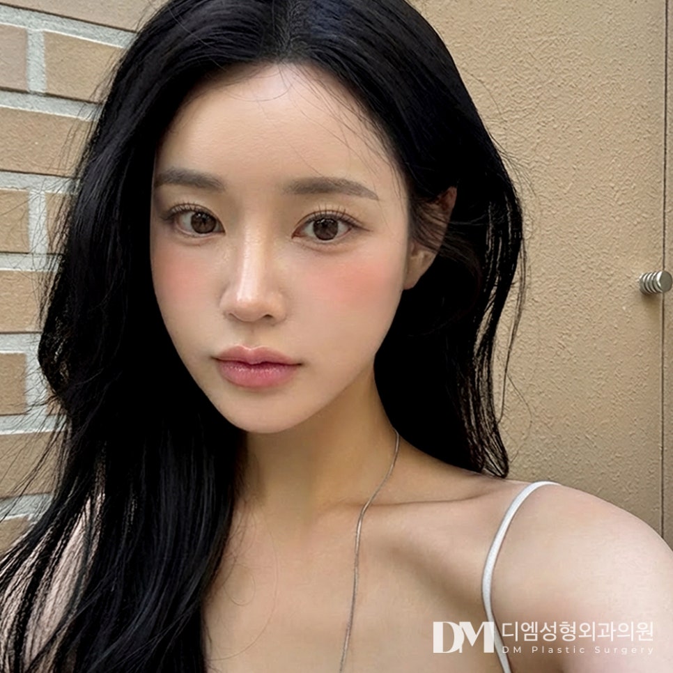 눈성형 후 토안증, 원인과 해결법은 무엇일까? 관련 이미지 10