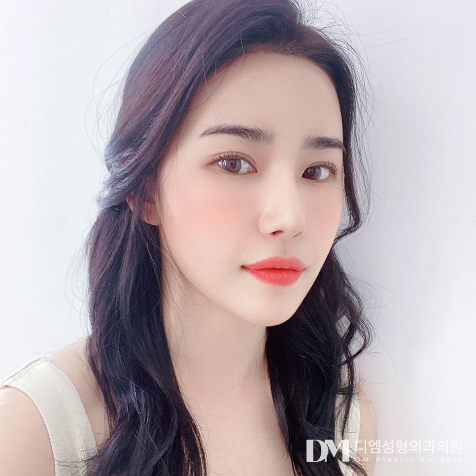 코재수술, 첫코성형 실패 원인 분석이 우선! 관련 이미지 1