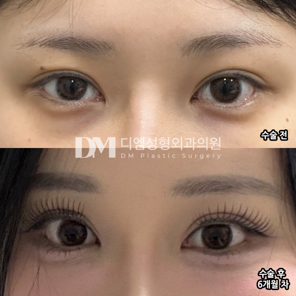 Eye Surgery Review: “I’m So Happy That I Can Really Compare Them with My Old Photos” image 2