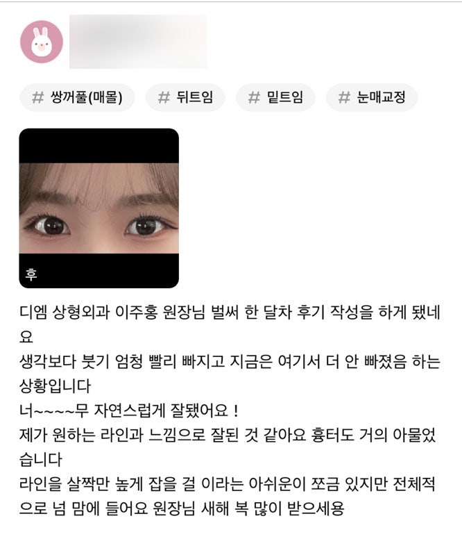눈성형 후기."너무 자연스럽게 잘 됐어요!" 관련 이미지 1