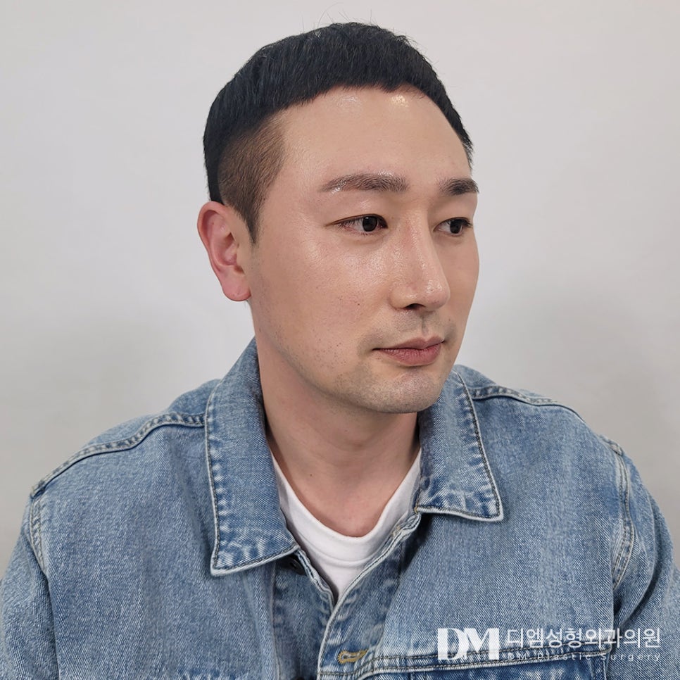 낮은코성형 , 만족도 높이려면? 관련 이미지 11